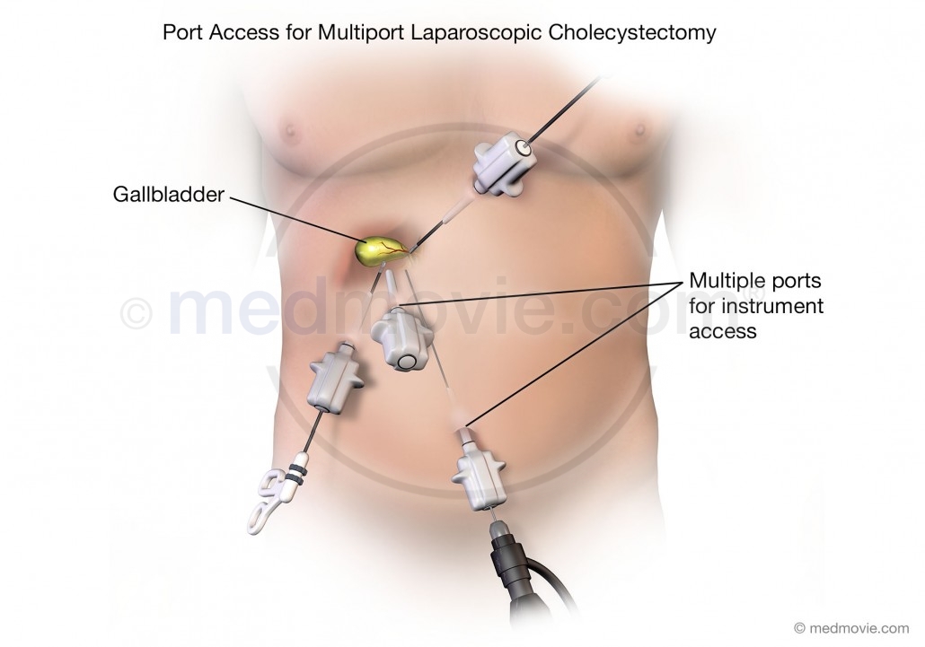 Port Access for Multiport Laparoscopic Cholecystectomy