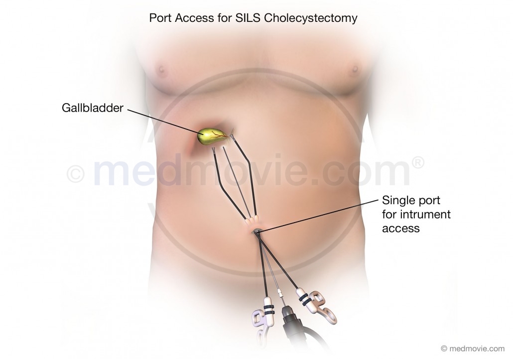 Port Access for SILS Cholecystectomy