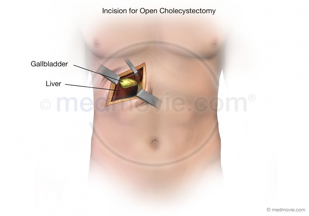 Incision for an Open Cholecystectomy Procedure