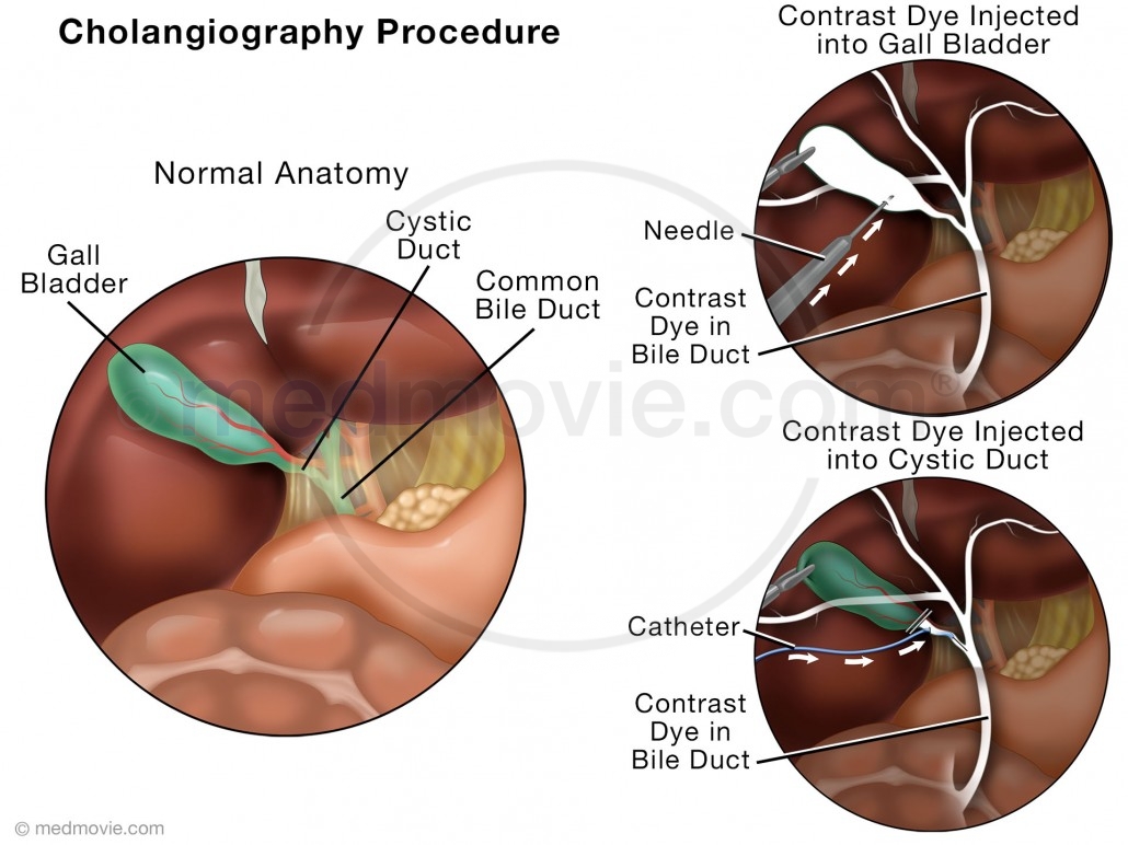 Cholangiography Procedure