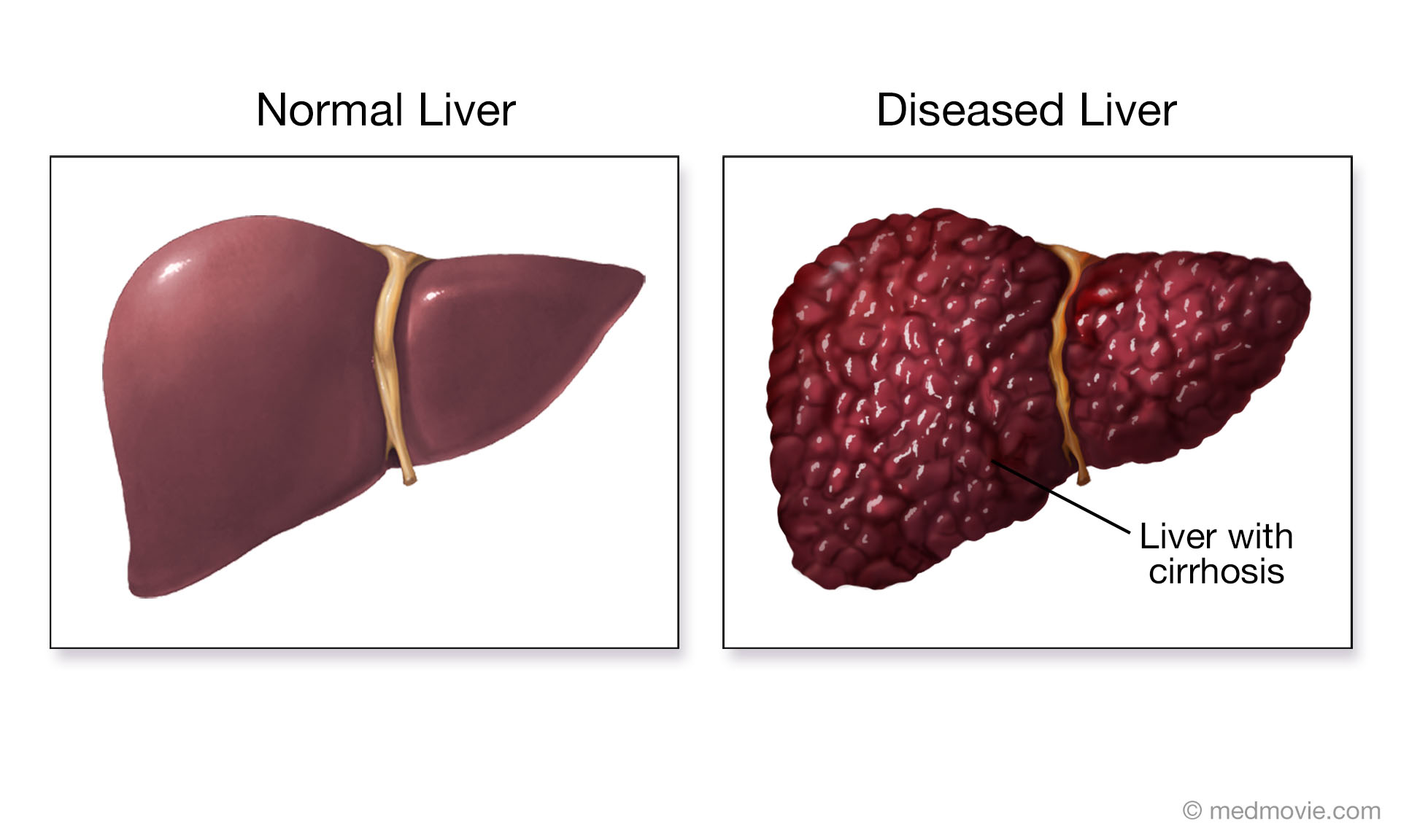 Normal Liver And Liver With Cirrhosis Medmovie Com