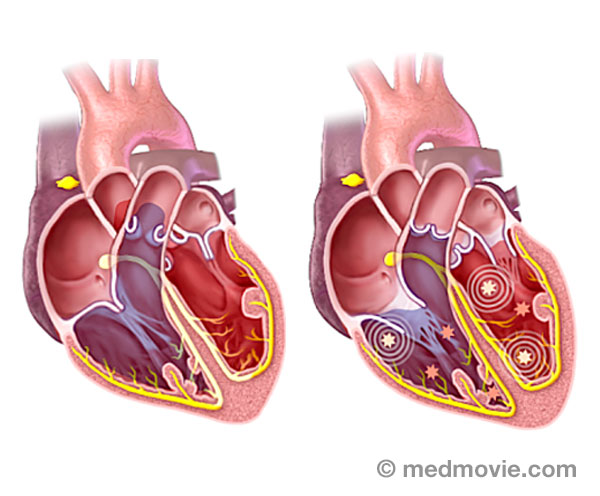 Heart Rhythm Society Electrophysiology Media Library