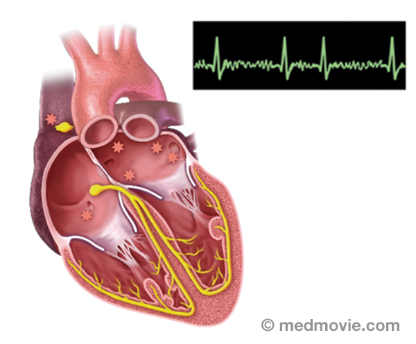 Heart Rhythm Society Electrophysiology Media Library