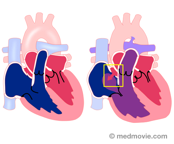 Patent Foramen Ovale