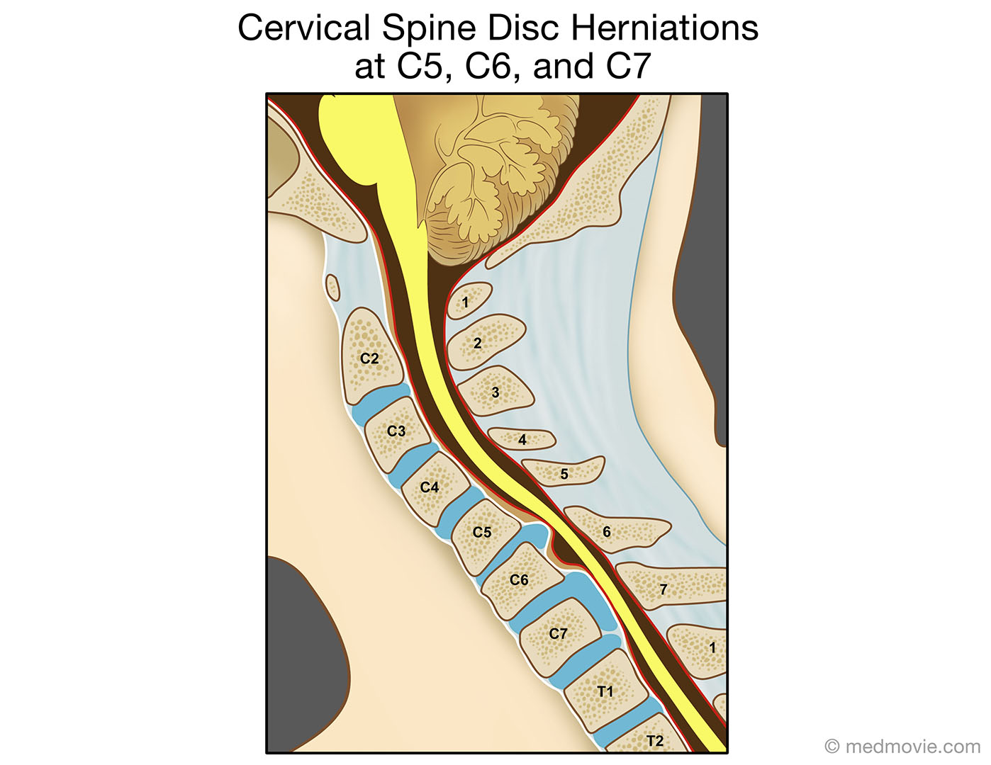Cervical Spine Disc Herniations At C5 C6 And C7
