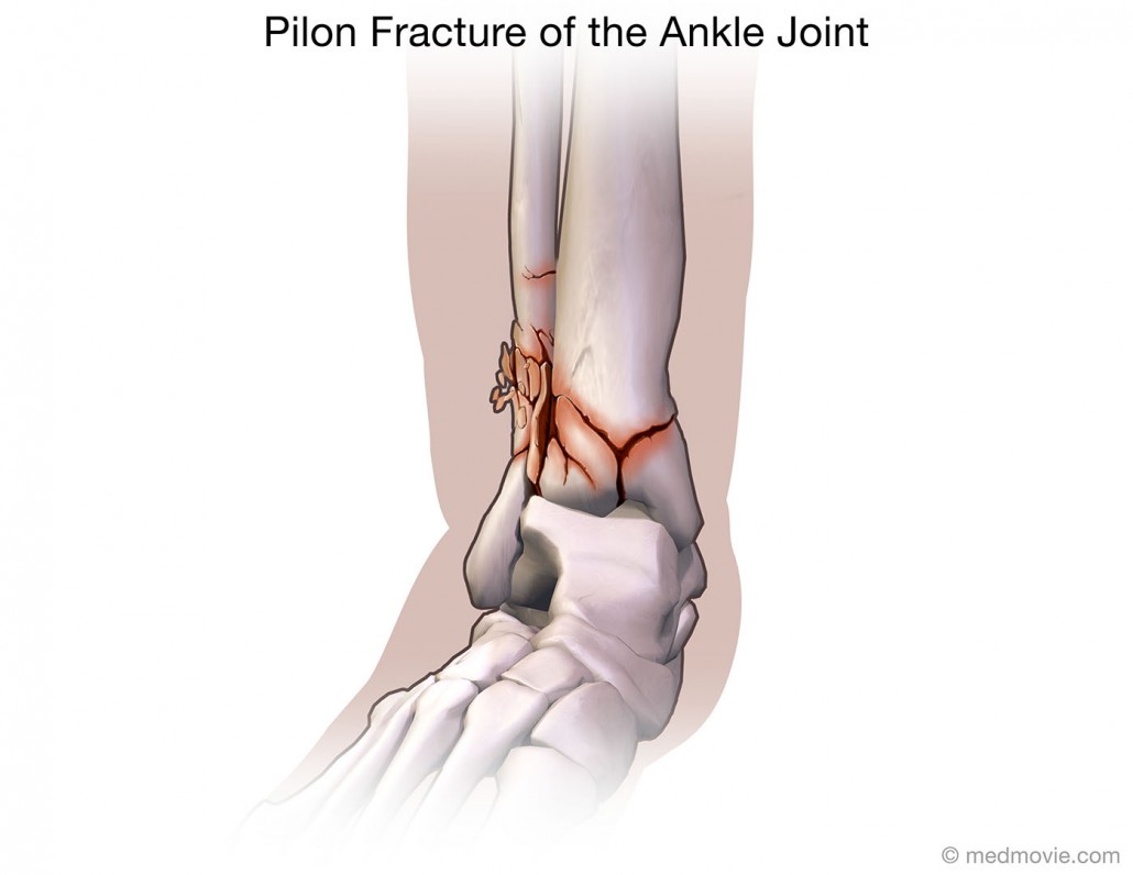 pilon fracture ankle