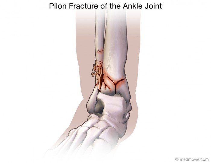 left ankle pilon fracture icd 10