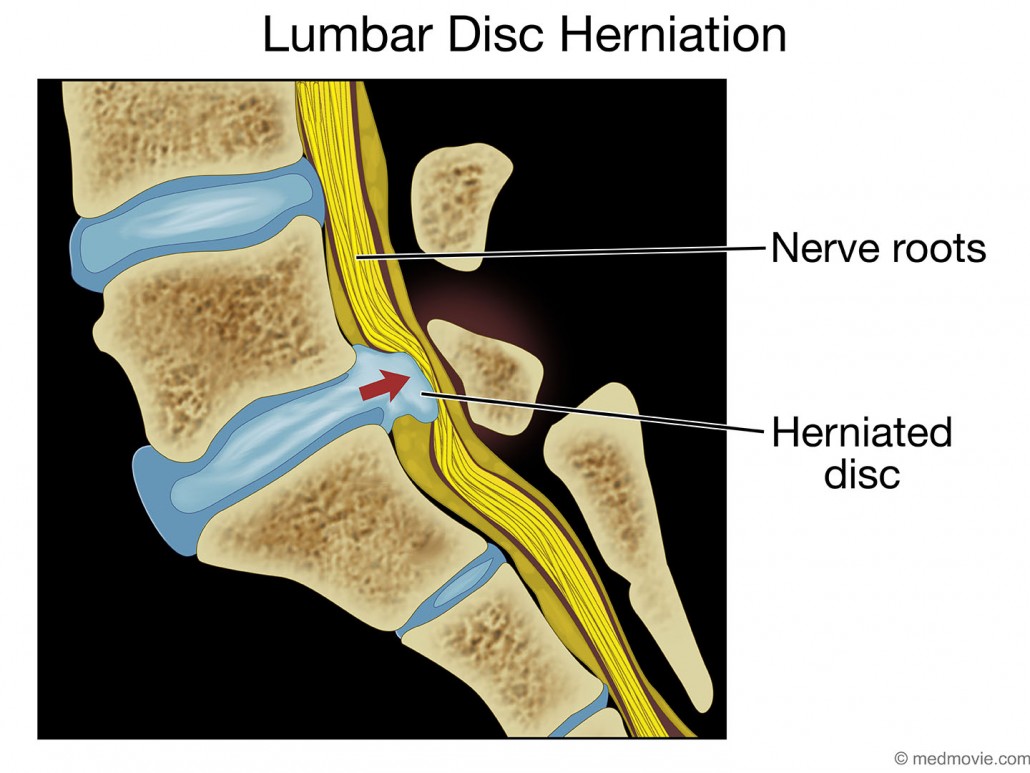 L Disc Herniation Medmovie Com