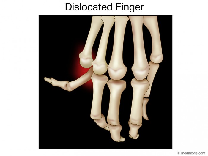 ml_0015_Dislocated_Finger