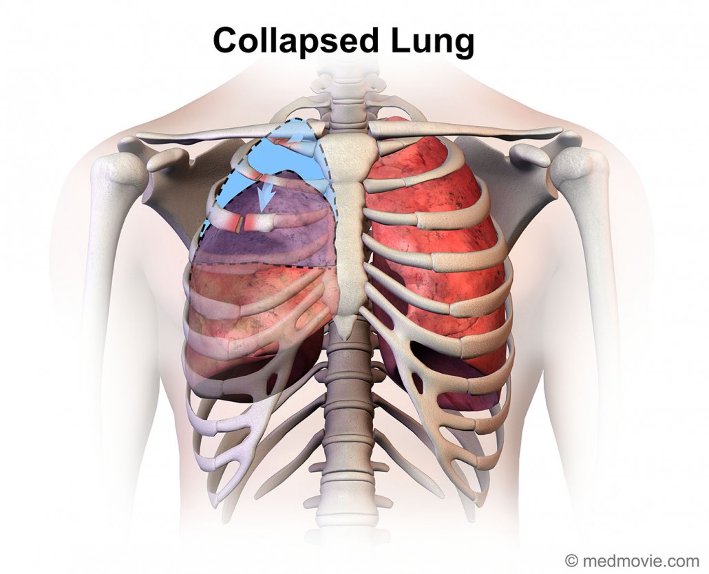 collapsed-lung-medmovie