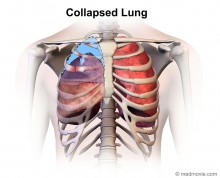 lung collapsed medmovie