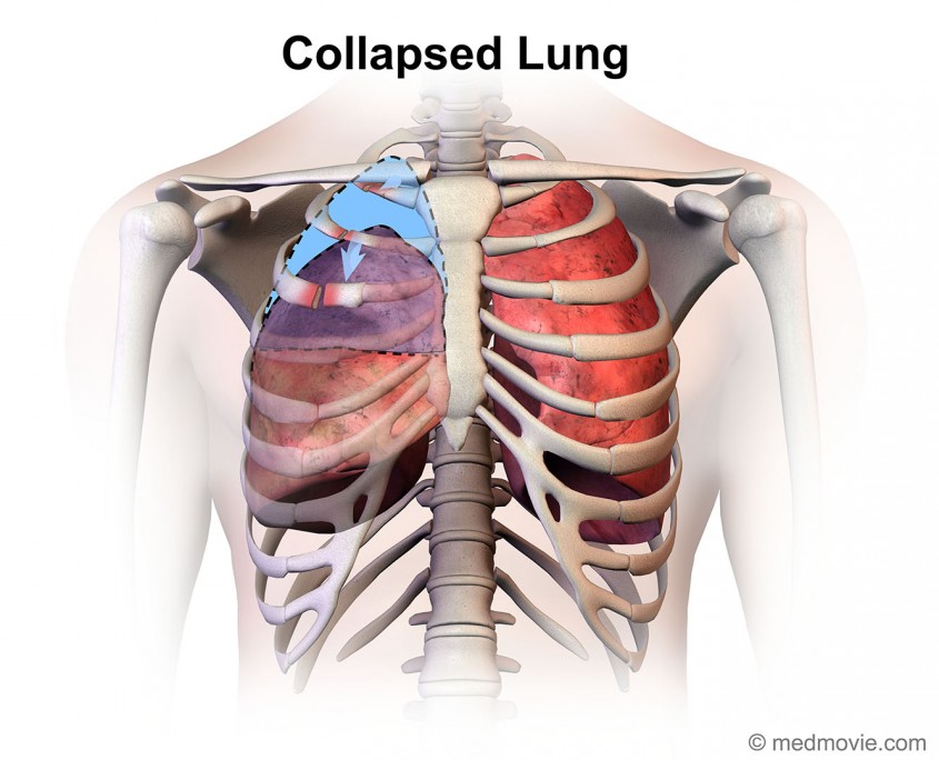 prevention-recovery-period-of-collapsed-lung-or-pneumothorax