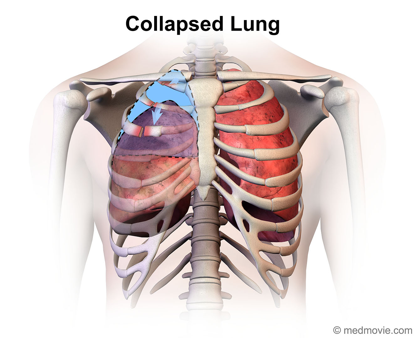 Collapsed Lung – Medmovie.com