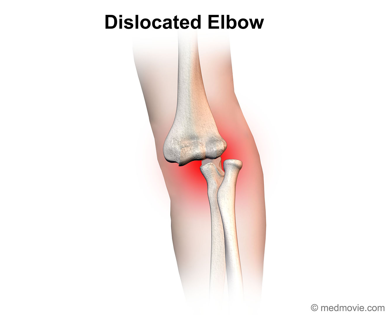 Elbow Dislocation 0842