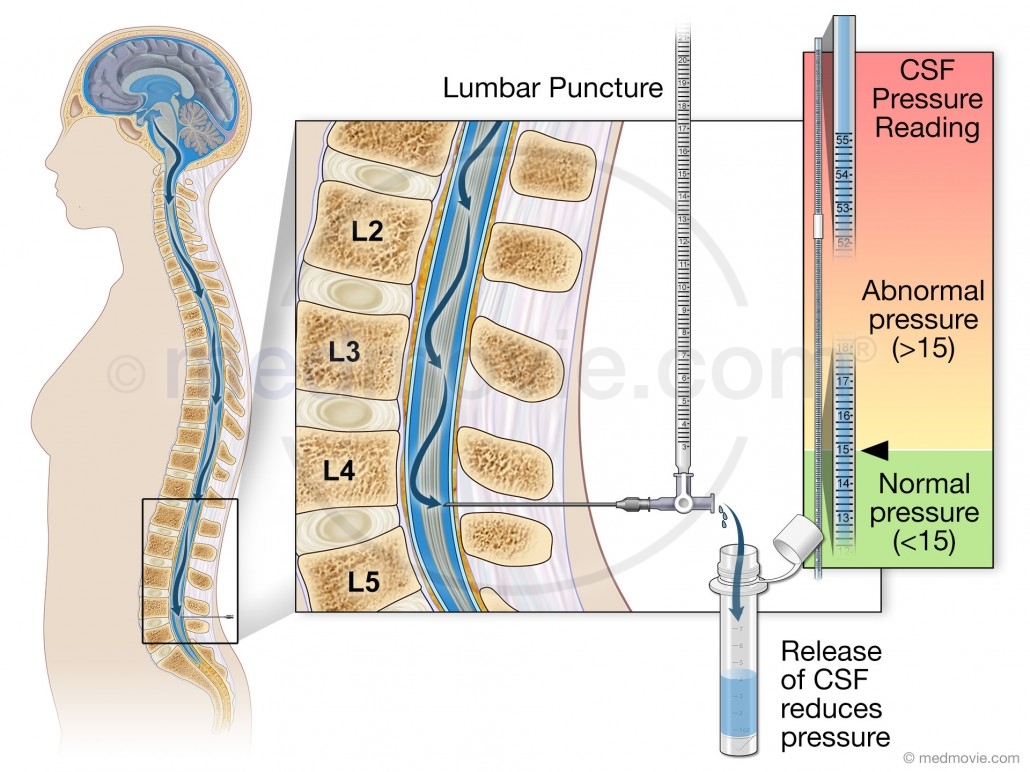 Lumbar Puncture – 