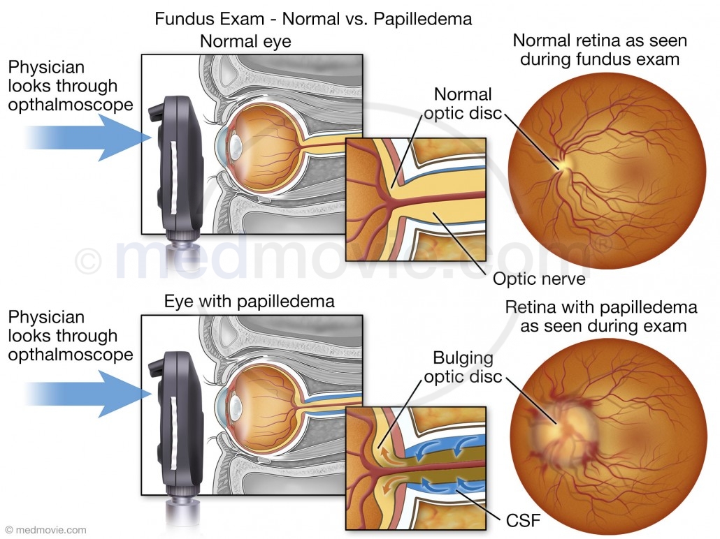 Fundus Exam - Normal versus Papilledema