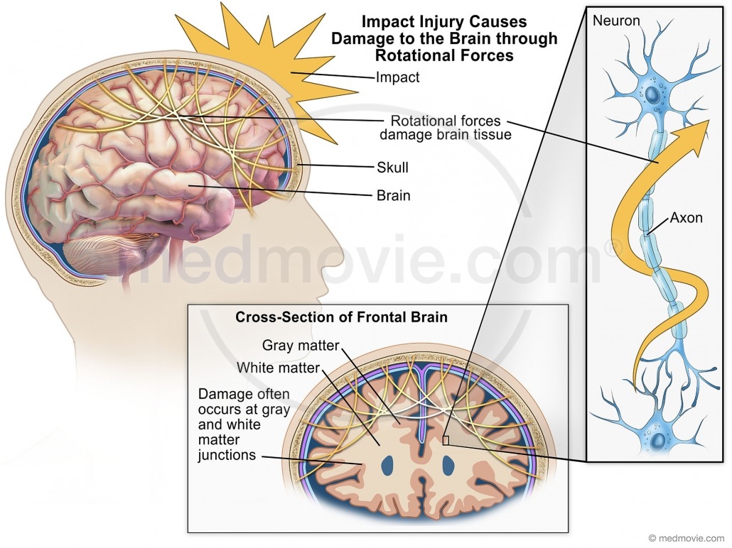 Brain Damage Caused by Impact Injury