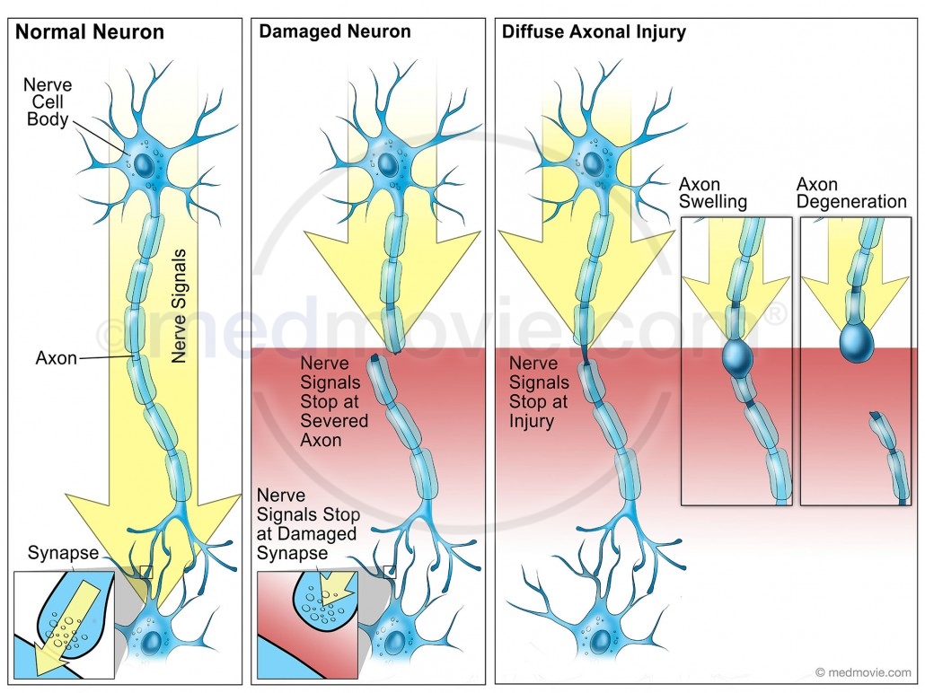 Damaged Neurons and Diffuse Axonal Injury
