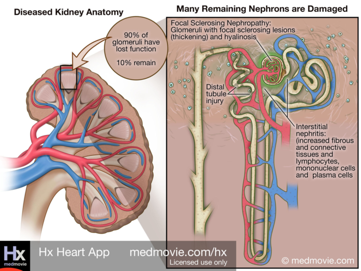 Kidney Failure