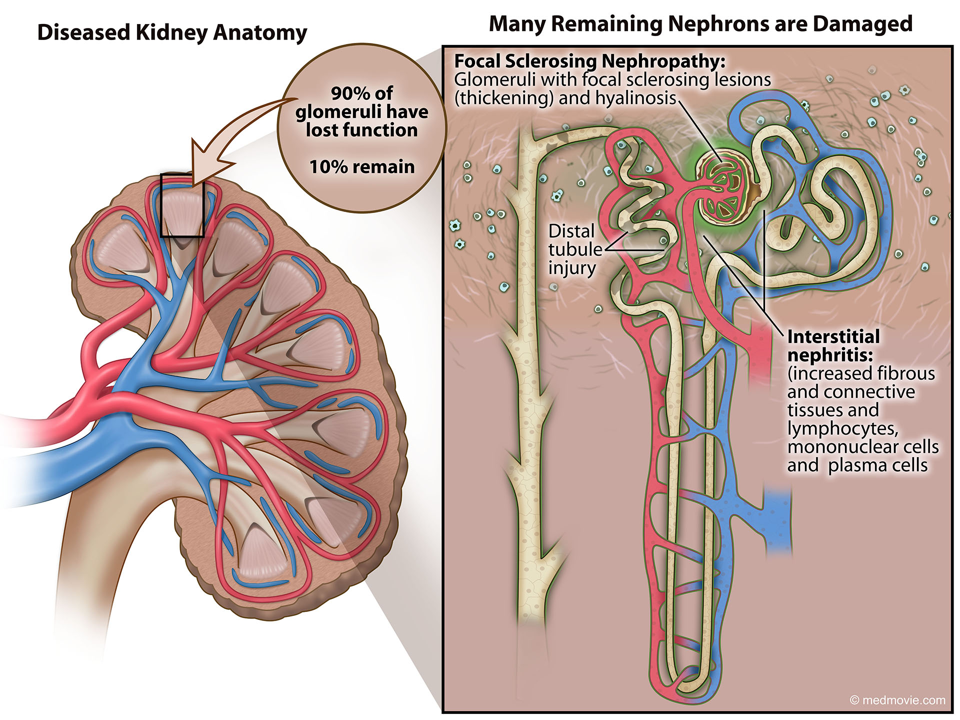 Kidney Failure – Medmovie.com