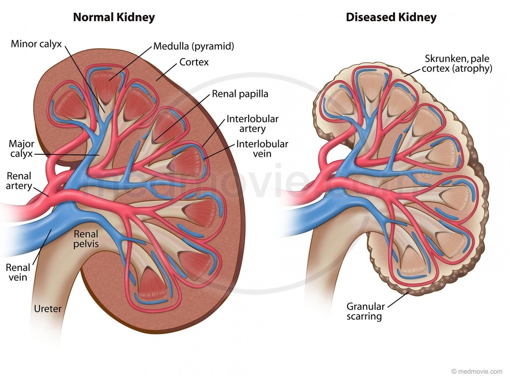 Normal Kidney Versus Kidney With Renal Failure Medmovie