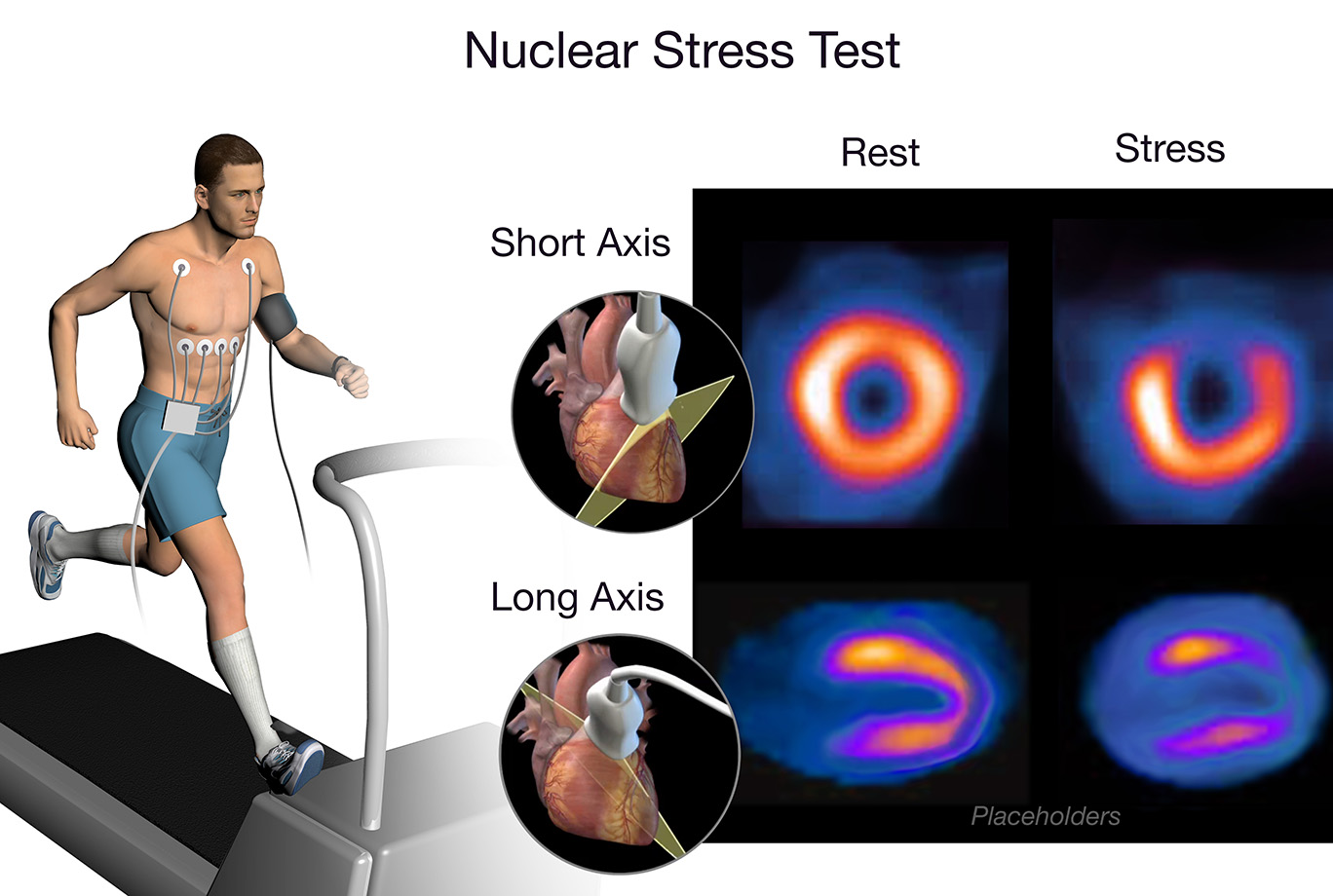 side-effects-and-precautions-after-nuclear-stress-test-health-checkup