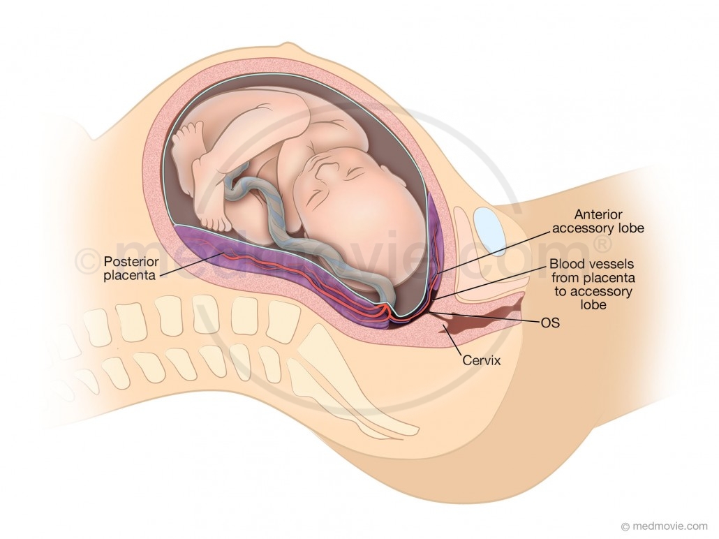 obml_0003_Placenta_Ant_Accessory 1030x772