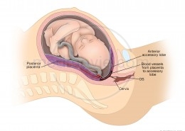 Placenta Anterior Accessory