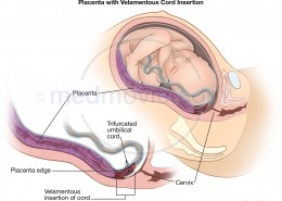 Placenta Velamentous Cord
