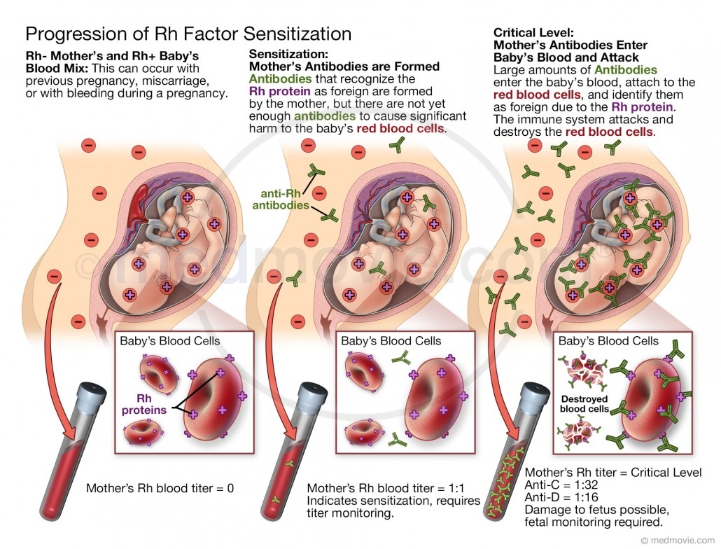 Rh Sensitization