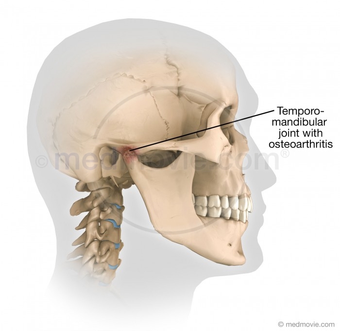 Temporomandibular Joint With Osteoarthritis 