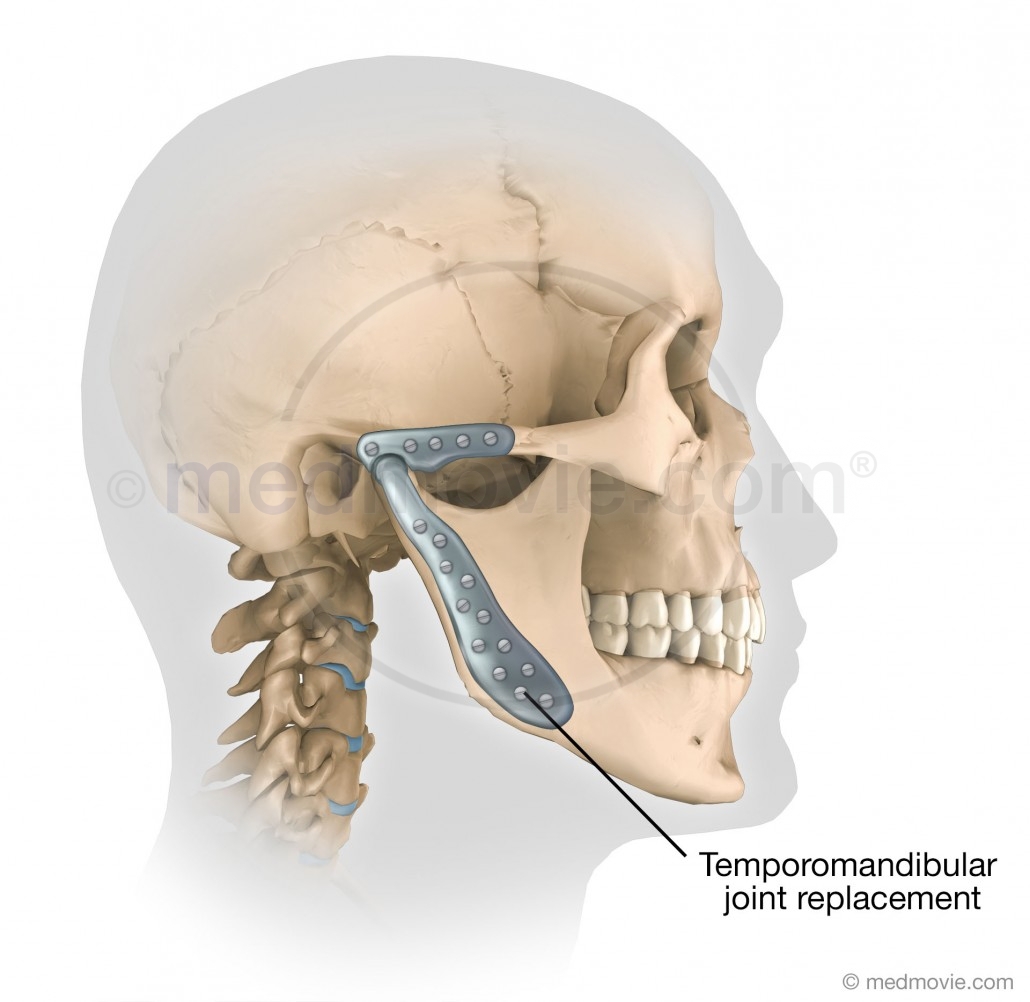 Temporomandibular Joint Remplacement