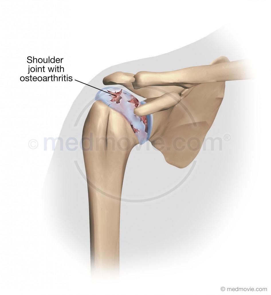 Shoulder Joint with Osteoarthritis