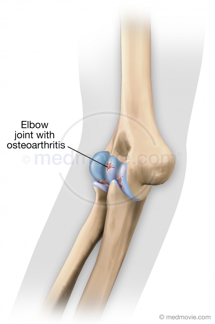 Elbow Joint with Osteoarthritis