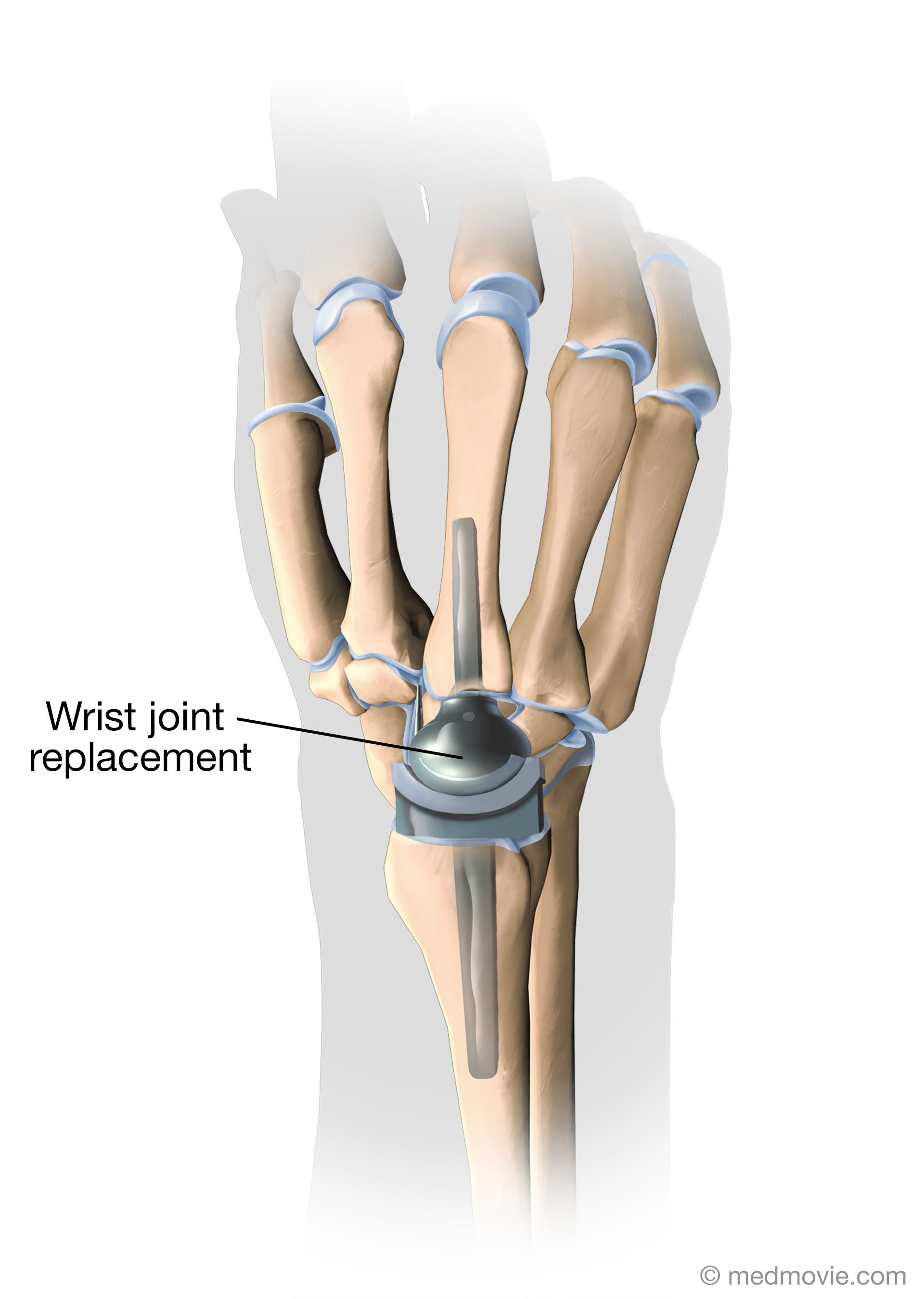 wrist-joint-replacement-medmovie