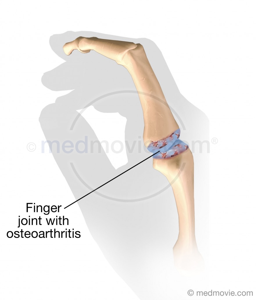 Finger Joint with Osteoarthritis