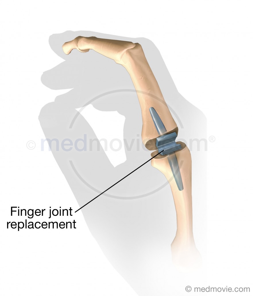 Finger Joint Replacement