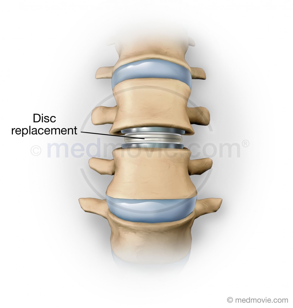 Intervertebral Disc Replacement