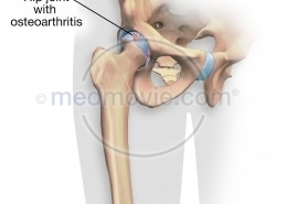 Hip Joint with Osteoarthritis