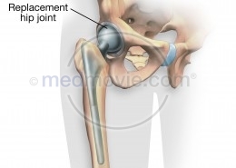 Replacement Hip Joint