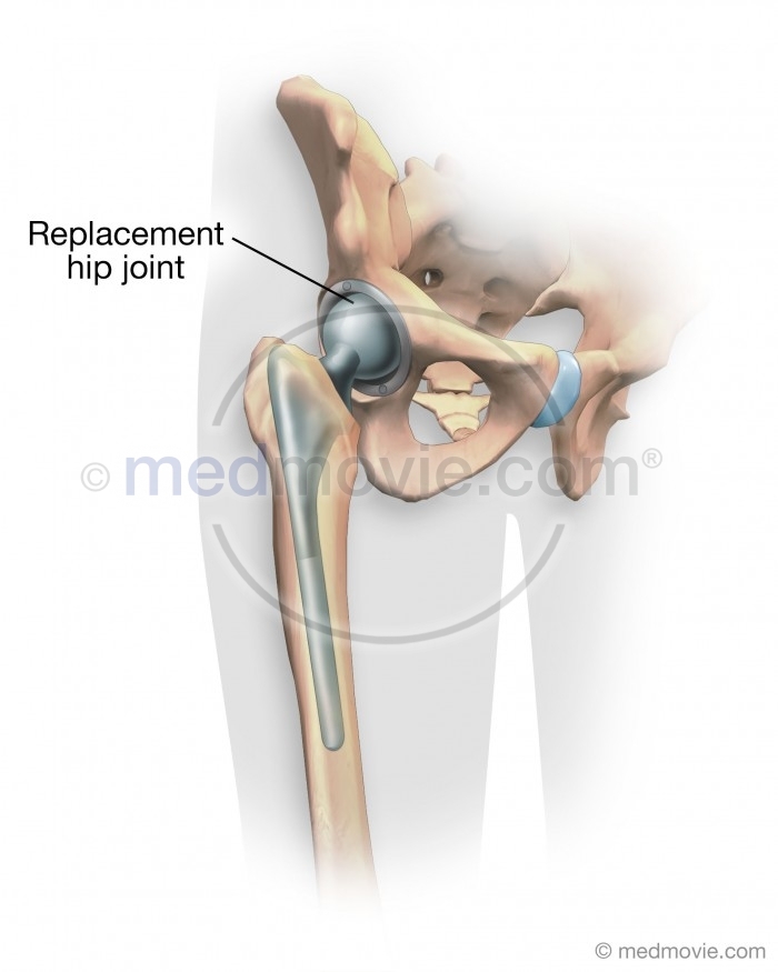 Replacement Hip Joint