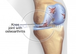 Knee Joint with Osteoarthritis