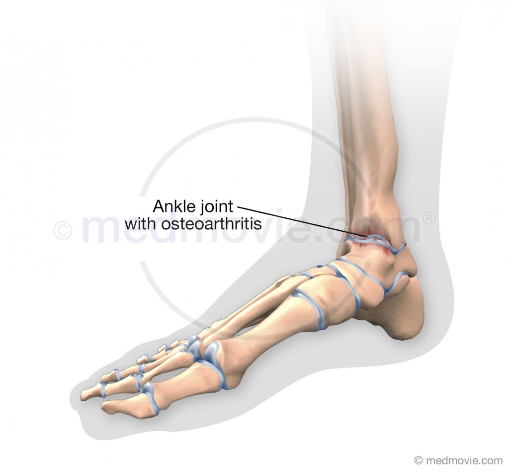 Ankle Joint with Osteoarthritis