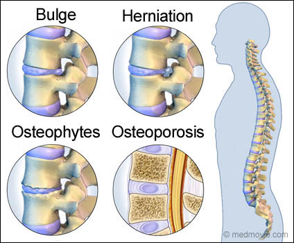 Pathologic Spinal Anatomy