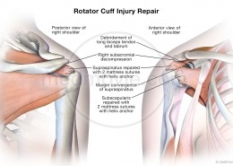Rotator Cuff Injury Repair