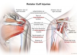 Rotator Cuff Injuries