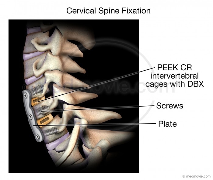 Cervical Spine Fixation – Medmovie.com