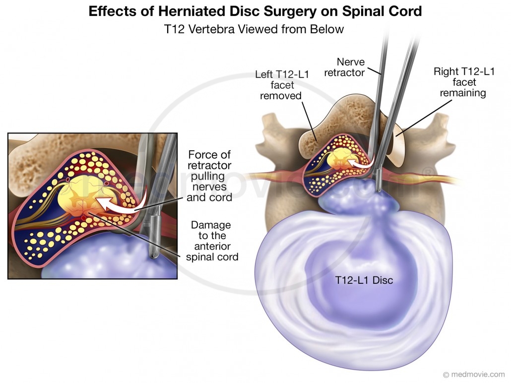 Herniated disc surgery at T12-L1 causing nerve damage