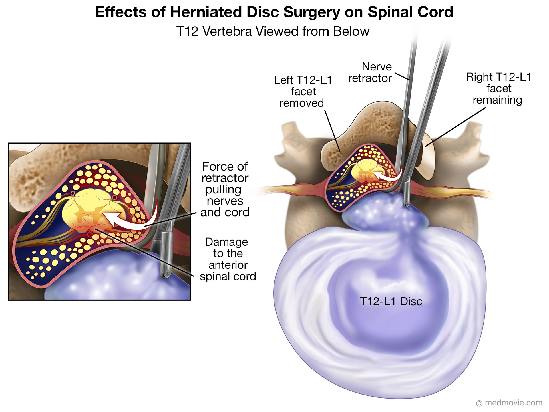 herniated-disc-surgery-at-t12-l1-causing-nerve-damage-medmovie