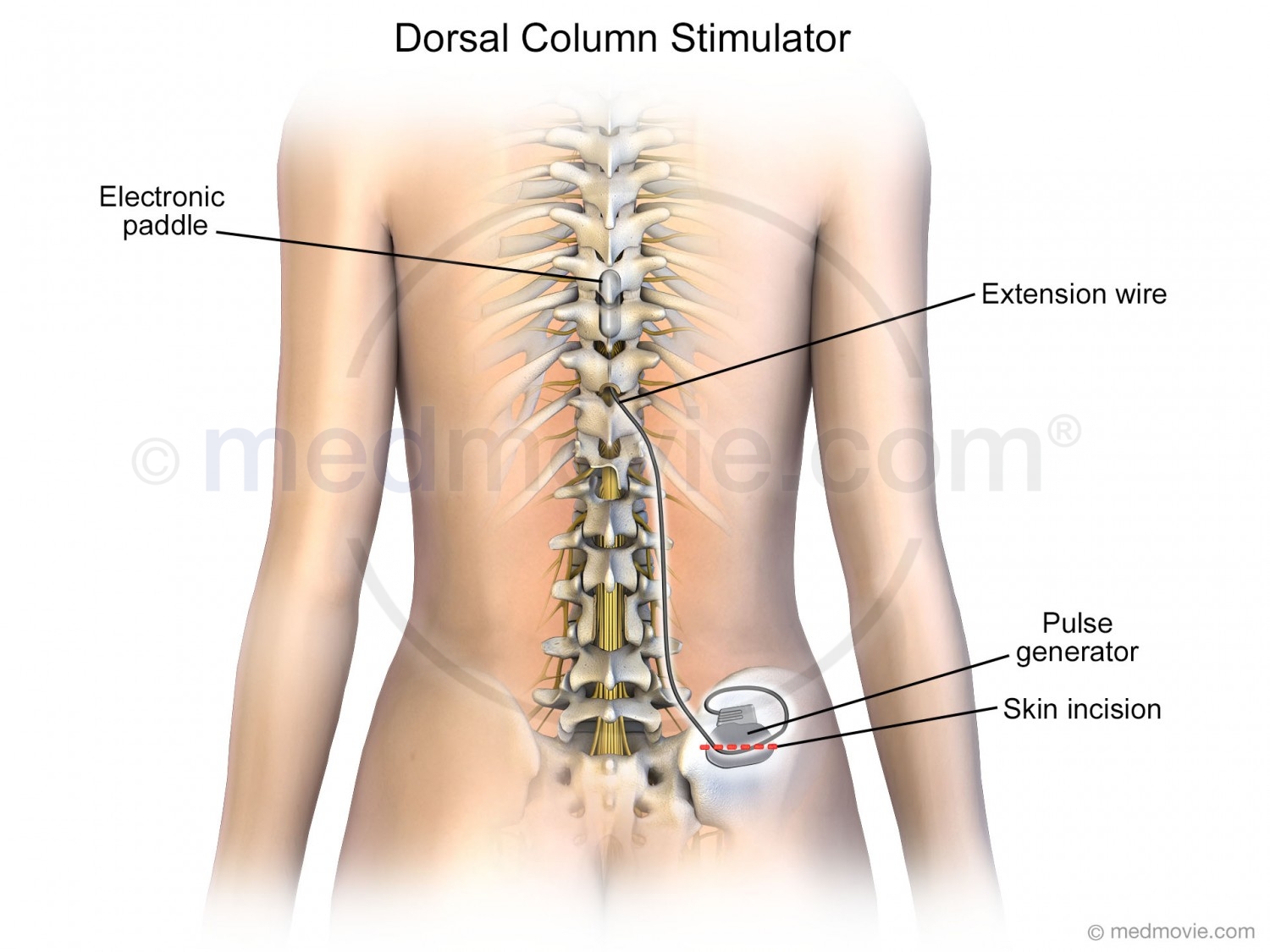 dorsal column stimulator paddle placement
